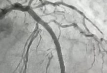 Hemodinâmica de Patos realiza procedimento cardiovascular de alta complexidade inédito no Sertão da Paraíba