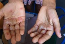 Mãe suspeita de queimar mãos da filha com ovos quentes é liberada em audiência de custódia